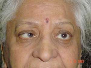 Cranial Nerve Palsy